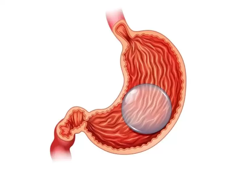 hangi-mide-balonunu-tercih-edelim