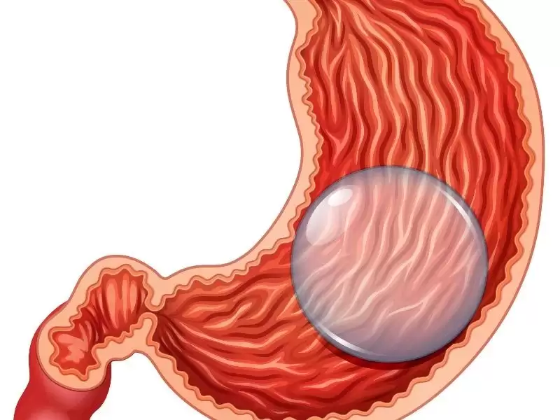 mide-balonu-cesitleri-ve-kilo-kaybi-etkileri