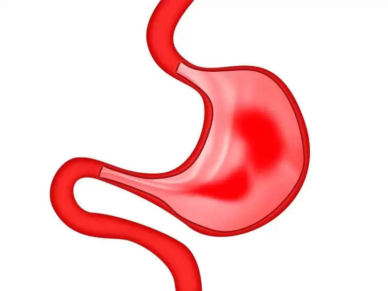 mide-balonu-mu-tup-mide-mi