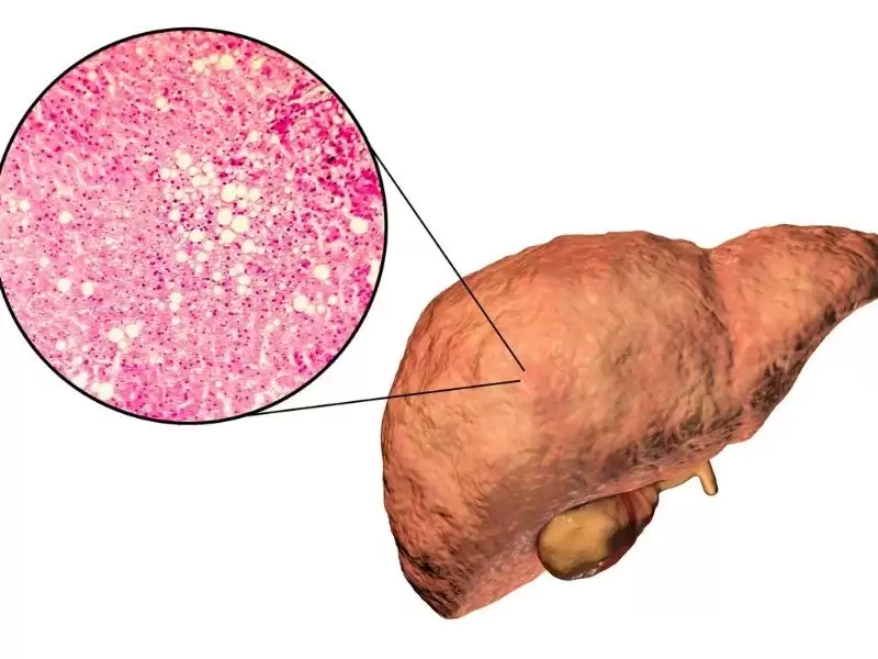 obezite-ve-karaciger-yaglanmasi