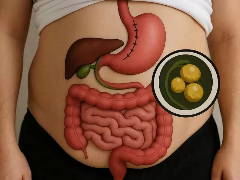 obezite-ameliyati-sonrasi-safra-tasi-olusumu